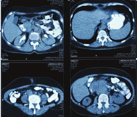 Abdominopelvic Ct With Oral And Intravenous Contrast During The