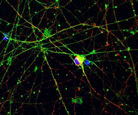 Reversing Als Cellular Symptoms In A Patient Derived Cell Model