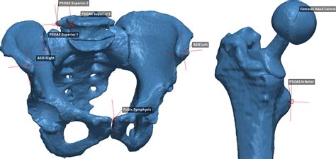Iliopsoas Tendonitis After Total Hip Arthroplasty Bone Joint