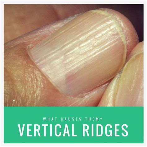 Nails Health Signs Lines In Nails Health Signs Vertical Ridges On