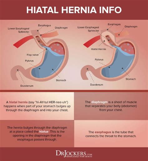 Does A Hiatal Hernia Cause High Blood Pressure Opera Residences