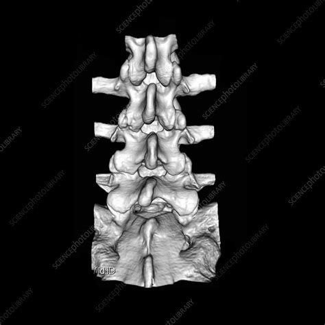 View Of Lumbar Spine Stock Image P1160785 Science Photo Library