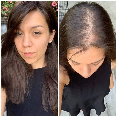 Update 135 Hair Toppers Before And After Super Hot Vn