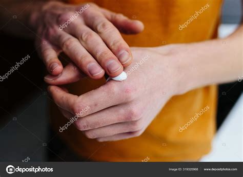 A psoríase pode afetar as unhas das mãos e dos pés, causando rachaduras, pequenas depressões, crescimento anormal e descoloração. Pomada nas mãos de um idoso. Aposentado aplicando pomada, cremes no tratamento de eczema ...