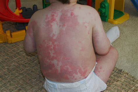 Erythema Multiforme Types Symptoms Causes Diagnosis