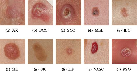Types Of Skin Lesions Top 10 Most Aggressive Types Of Cancer Skin