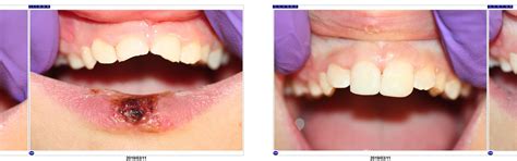 Fractured Front Teeth Repaired With Composite Mcfarlane Dental