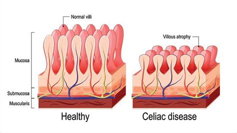 Celiac Disease Causes And Risk Factors