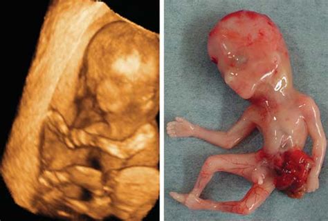 The signals bounce back and produce images that can help diagnose conditions or take measurements inside the body.1 Omphalocele at 12 weeks of gestation. (Left) 3D ultrasound ...