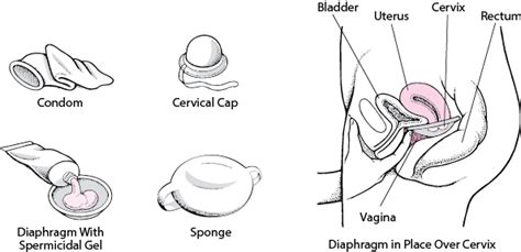 Cervical Cap Vs Soft Cup