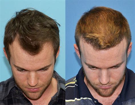 25 Year Old Male Hairline Restoration Carolina Hair Surgery