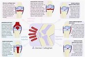 Knee Pain - Denise Callaghan