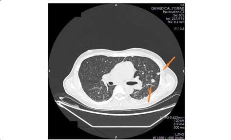 Ct Pictures Displaying Multiple Tuberculosis Lesions Throughout The