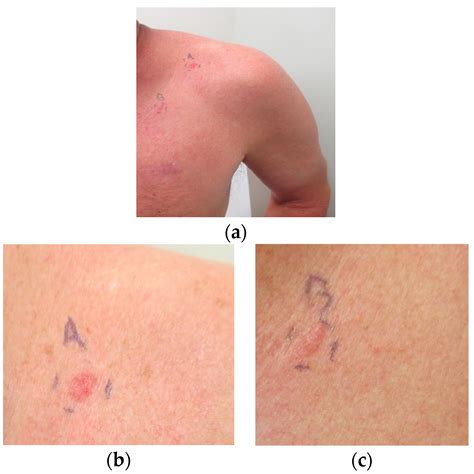 Ijms Free Full Text Appearance Of New Cutaneous Superficial Basal