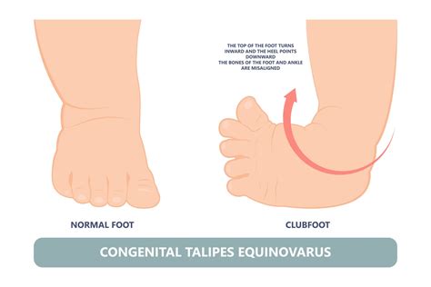 Clubfoot Symptoms Causes And Treatments Advanced Surgery Center