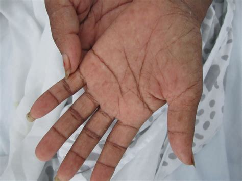 Presumed Syphilis Rash On Palms Hôpital Sacré Coeur Medical Reports