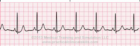 Sinus Rhythms Reference Page EKG Academy