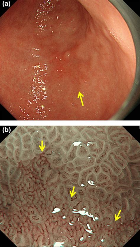 Guidelines For Endoscopic Diagnosis Of Early Gastric Cancer Yao