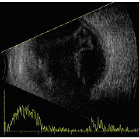 B Scan Ultrasonography Showing Evidence Of Vitreous Abscess With An