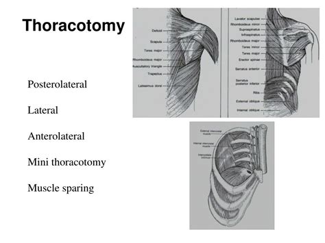 Ppt Thoracic Surgery Powerpoint Presentation Free Download Id1816662
