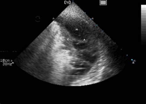 See full list on journals.lww.com Consolidated lung and adjacent pleural effusion with pl | Open-i