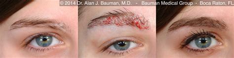 Eyebrow Scar Hair Transplant · Bauman Medical