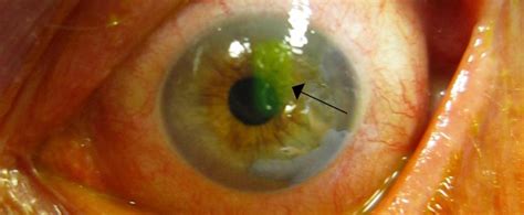 Recurrent Corneal Erosions The Canadian Association Of Optometrists