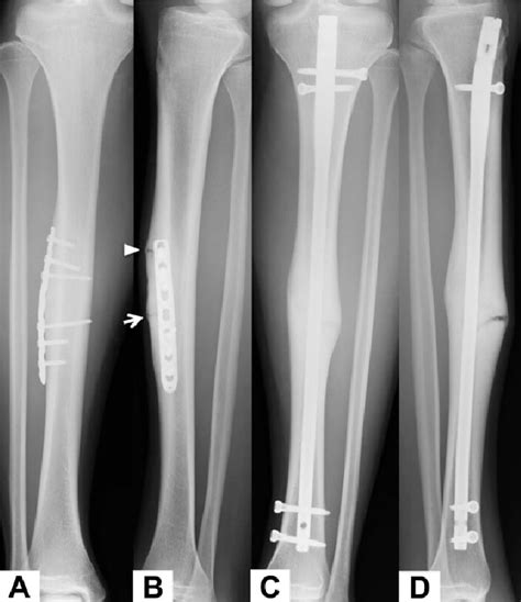 Recurrent Fracture After Anterior Tension Band Plating With Bilateral