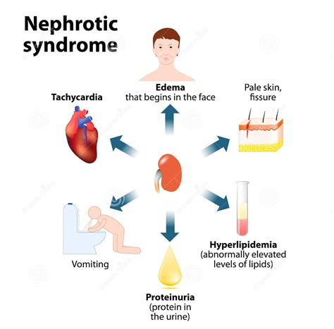 Nephrotic Syndrome Causes Signs Symptoms Diagnosis Treatment