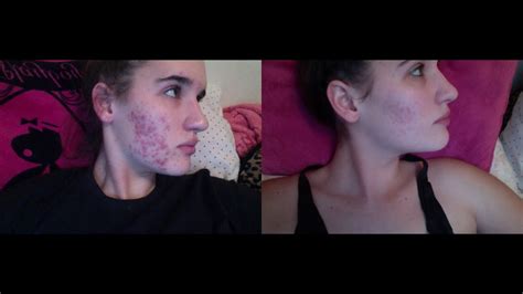 My Acne Story Spironolactone Before And After Pictures Youtube