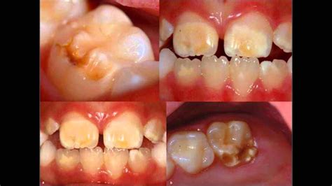 Anomalias Dentales Wmv