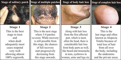 Alopecia Areata Treatment Dermadock In