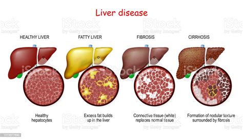 Liver Diseases Stages Of Liver Damage Stock Illustration Download