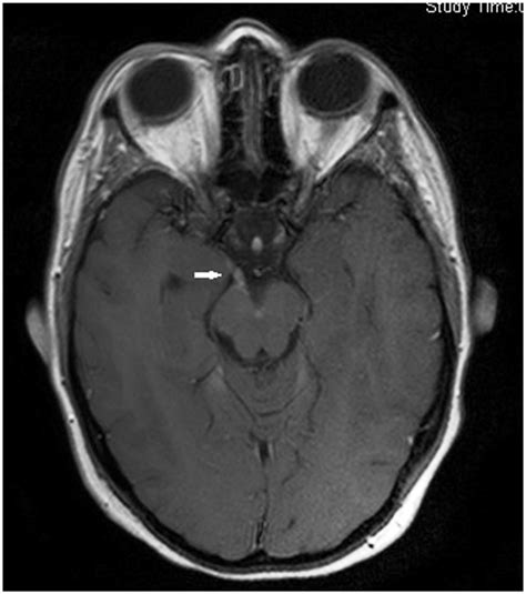 T1 Weighted Axial Mri With Contrast Showing Contrast Enhancement Along