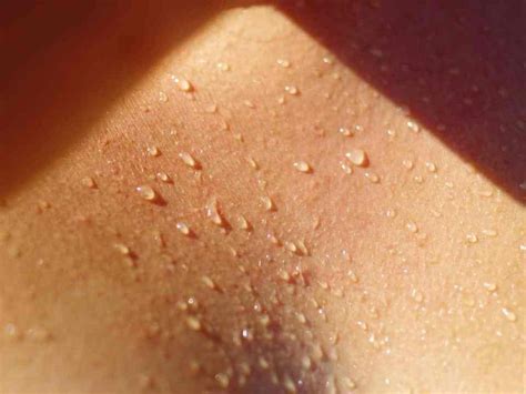 La Alergia Al Sol ¿qué Es Y Cuáles Son Sus Síntomas
