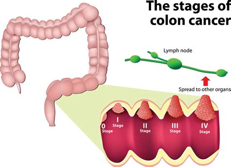 Colon Cancer Stages Moffitt