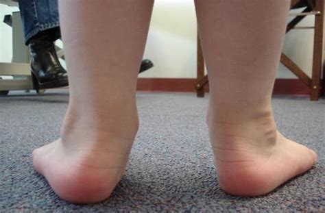 Overpronation Causes Treatment And Exercises