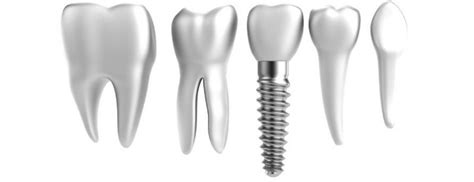 Mini Dental Implants Docdentalsmile