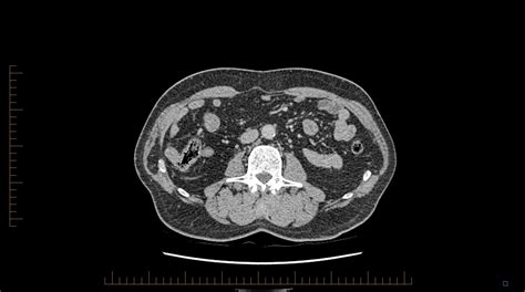 Radiology Cases Abdominal Parietal Hernias At The Costal Margin