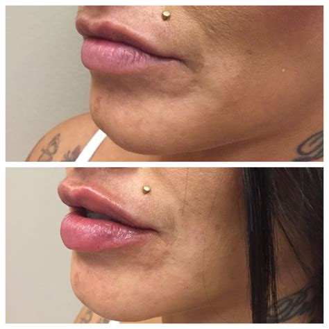 Dermal Filler Before And After Onyx Integrative Medicine And Aesthetics