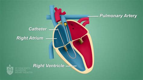 If you have isolated dextrocardia, your heart is located on the right side of your chest, but it has no other defects. Right Heart Catheter - St Vincent's Lung Health