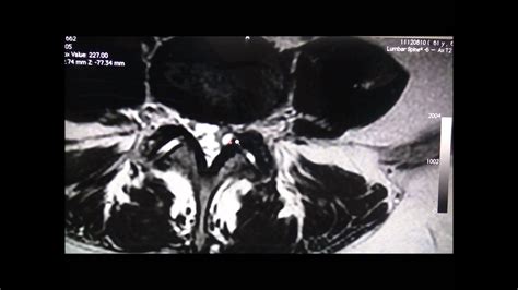 Facet Joint Cyst Uk Youtube