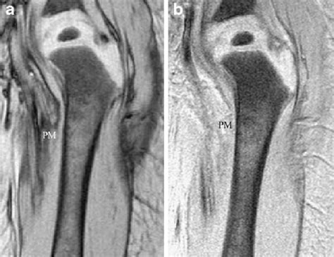 Mr Imaging Of The Femoral Marrow In A 2 Year Old Boy With Thalassemia