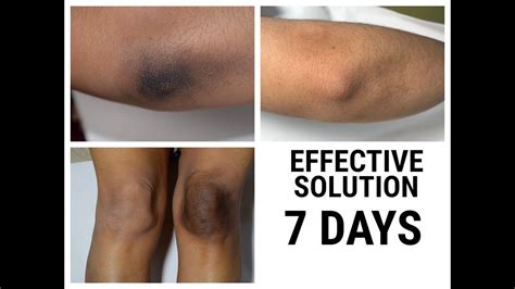 Dark Elbows And Knees Lighten Fast Result At Home By Easy Beauty