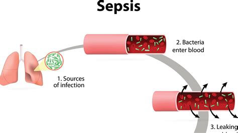 What You Need To Know About Sepsis In Children