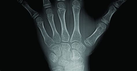 Medical Dentix Qué es una radiografía carpal