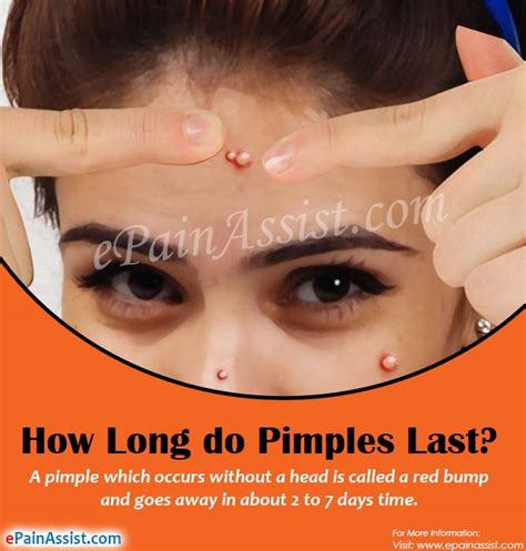 Acne is a long term condition of skin involving oil glands at the base of a hair follicle that can cause. How Long do Pimples Last & Ways to Get Rid of it Fast?