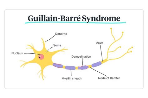 Guillain Barre Syndrome Vector Illustration Labeled Muscle Disease