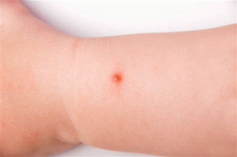 Mosquito Bite Child Stock Photos Pictures And Royalty Free Images Istock