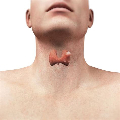 Thyroid Cancer Thyroid Cancer Papillary Carcinoma Causes Symptoms